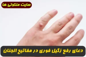 دعای رفع زگیل فوری,دعای رفع زگیل در مفاتیح الجنان,دعای رفع زگیل صورت و پا
