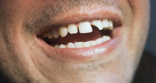 تعبیر خواب افتادن دندان همراه با خونریزی - تعبیر ریزش دندان