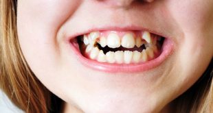 تعبیر خواب دندان و جرم دندان - دیدن دندان مصنوعی در خواب نشانه چیست