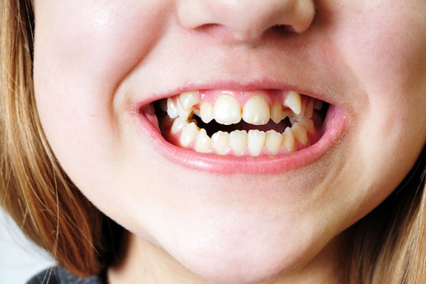 تعبیر خواب دندان و جرم دندان - دیدن دندان مصنوعی در خواب نشانه چیست